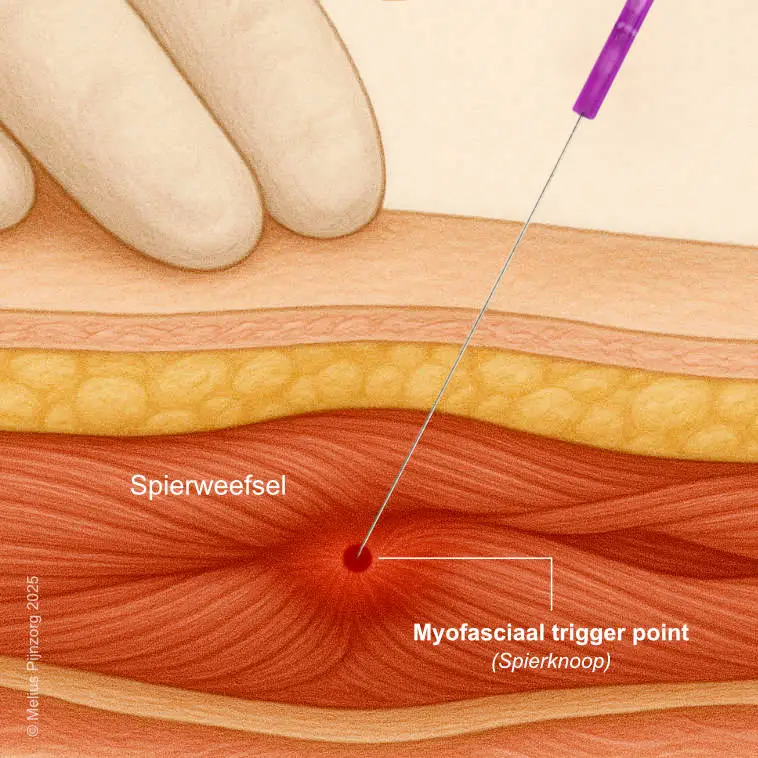 Doorsnede huid met dry needling naald in triggerpoint schouder
