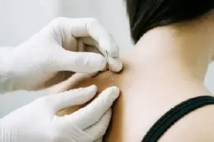 Dry needling behandeling door fysiotherapeut