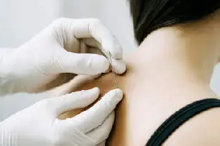 Dry needling behandeling door fysiotherapeut